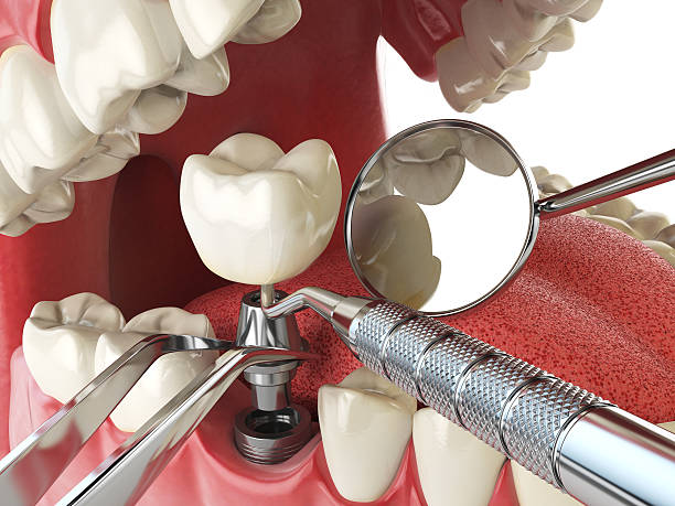 Best Emergency Broken Tooth Repair in Riddle, OR